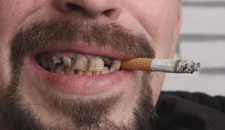 牙齿缝隙有黑黑的可以抠下来(牙齿缝隙间有黑色的东西能抠掉)