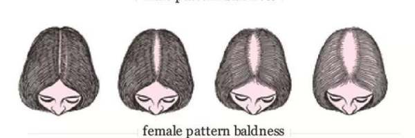 压力大脱发怎么改善(最近工作压力大掉头发怎么治)