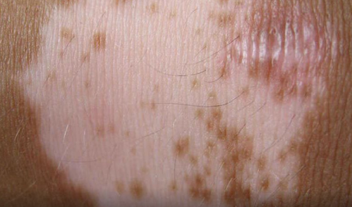 突然长出白斑是什么原因图片(突然长白斑是什么原因背后)