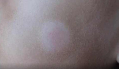 突然长出白斑是什么原因图片(突然长白斑是什么原因背后)