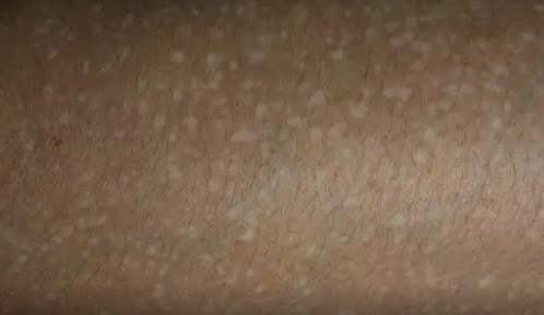 突然长出白斑是什么原因图片(突然长白斑是什么原因背后)