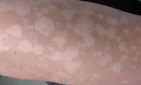 突然长出白斑是什么原因图片(突然长白斑是什么原因背后)