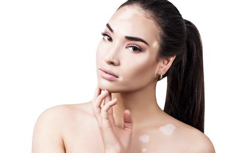 突然长出白斑是什么原因图片(突然长白斑是什么原因背后)