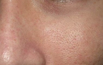 运动能收缩毛孔(运动能收缩毛孔么)