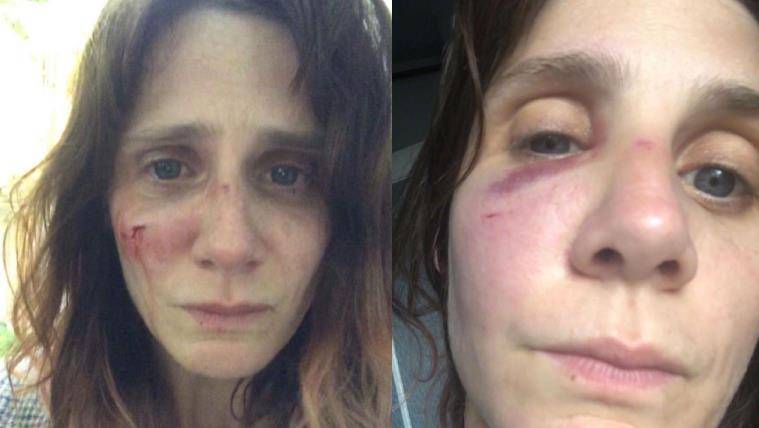 著名女演员希拉被她的前男友强奸了！面部淤青、肿胀、出血都很痛苦。