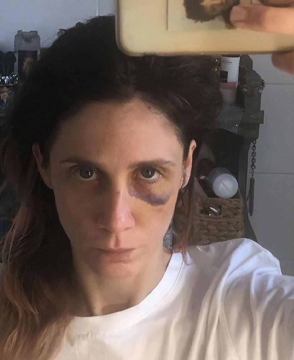 著名女演员希拉被她的前男友强奸了！面部淤青、肿胀、出血都很痛苦。