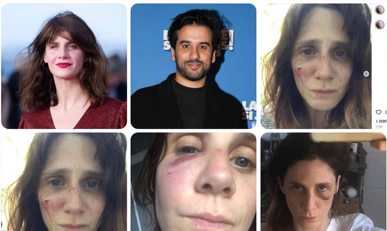 著名女演员希拉被她的前男友强奸了！面部淤青、肿胀、出血都很痛苦。