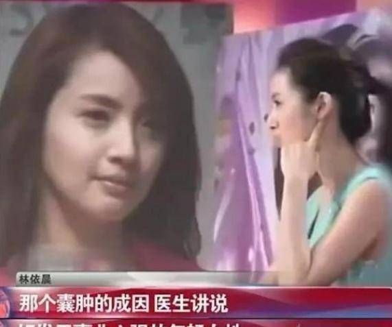 林依晨有癌症(林依晨一生)