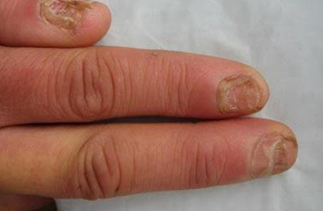 灰指甲最开始的症状会发脓吗图片(灰指甲最开始的症状会发脓吗怎么治疗)