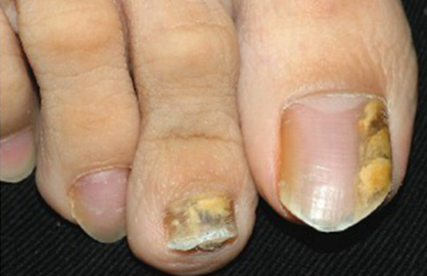 灰指甲最开始的症状会发脓吗图片(灰指甲最开始的症状会发脓吗怎么治疗)