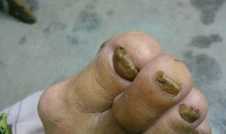 灰指甲最开始的症状会发脓吗图片(灰指甲最开始的症状会发脓吗怎么治疗)