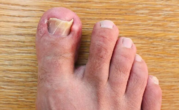 甲沟炎怎么治疗才能彻底除根最新(甲沟炎怎么治疗才能彻底除根不动)