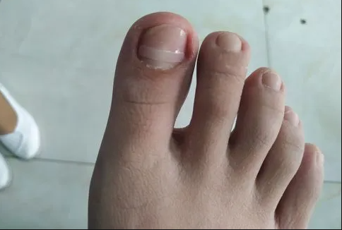 甲沟炎怎么治疗才能彻底除根最新(甲沟炎怎么治疗才能彻底除根不动)