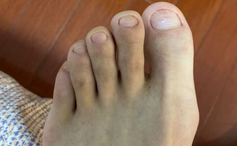 修脚店是不是不管你有没有灰指甲都说你有(修脚店真的可以治疗灰指甲吗)