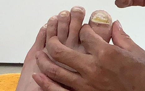 修脚店是不是不管你有没有灰指甲都说你有(修脚店真的可以治疗灰指甲吗)