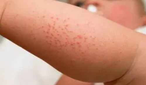 宝宝痱子怎么快速消除止痒(宝宝痱子怎么快速消除)