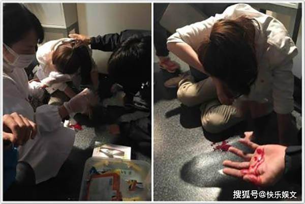 36岁杨幂的伤况！眼睛缝针需要包扎，三天换一次药，伤势已经稳定。