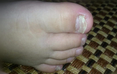 修脚店是不是不管你有没有灰指甲都说你有(修脚店真的可以治疗灰指甲吗)