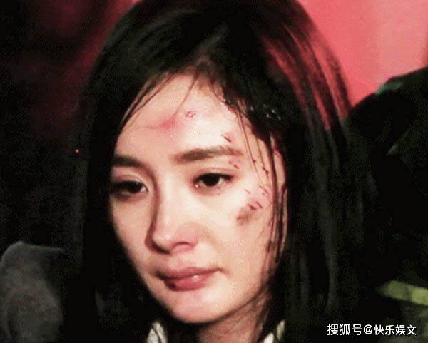 36岁杨幂的伤况!眼睛缝针需要包扎,三天换一次药,伤势已经稳定。