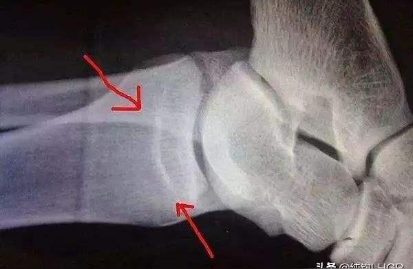 如何在家里判断骨骼线怎么看骨龄片子几岁