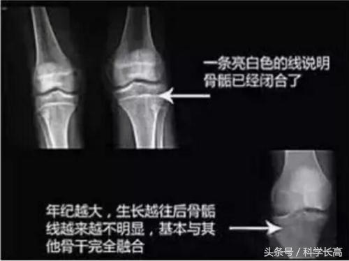 22岁骨骺线闭合了吗18岁到22岁最多能长多高