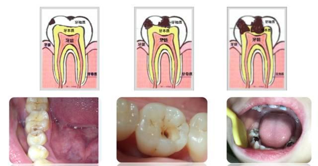 蛀牙如何让它停止腐蚀你觉得可以吃什么药止痛
