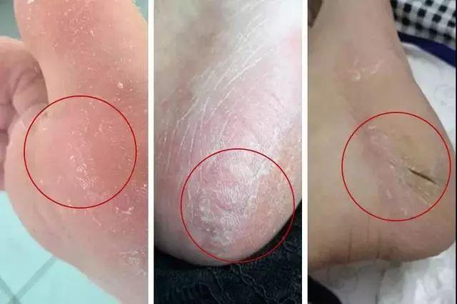 脚后跟干裂起硬皮是什么原因脚后跟干裂口子怎么办呢