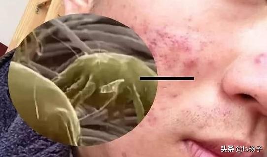 下边一到晚上就特别痒怎么办晚上睡觉很痒