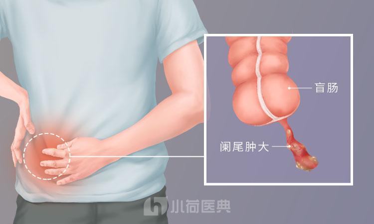 阑尾炎是哪个部位疼阑尾炎在身体哪个部位