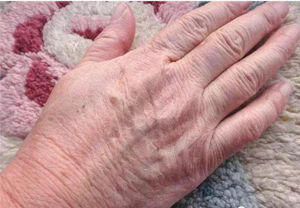 蛋蛋痒痒越抓越痒挂什么科瘙痒是怎么治疗