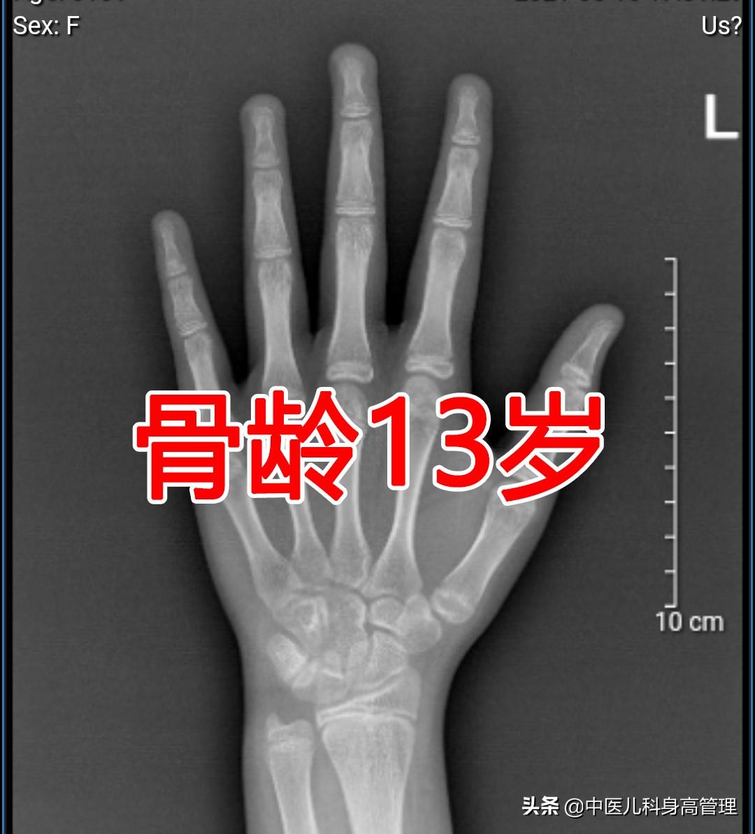 骨骺线闭合长高的方法初二去医院测骨龄说骨骼线闭合