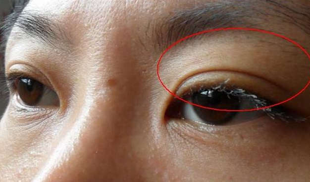 眼皮浮肿是什么原因引起的,下眼皮肿了怎么回事