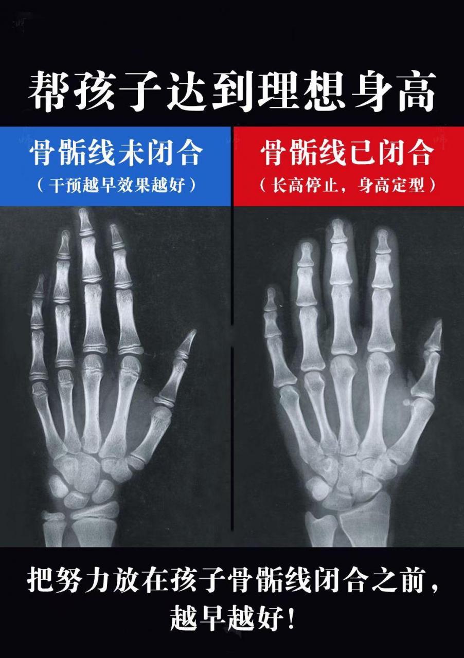 骨骺线闭合了怎么再长高手腕骨骼线基本闭合