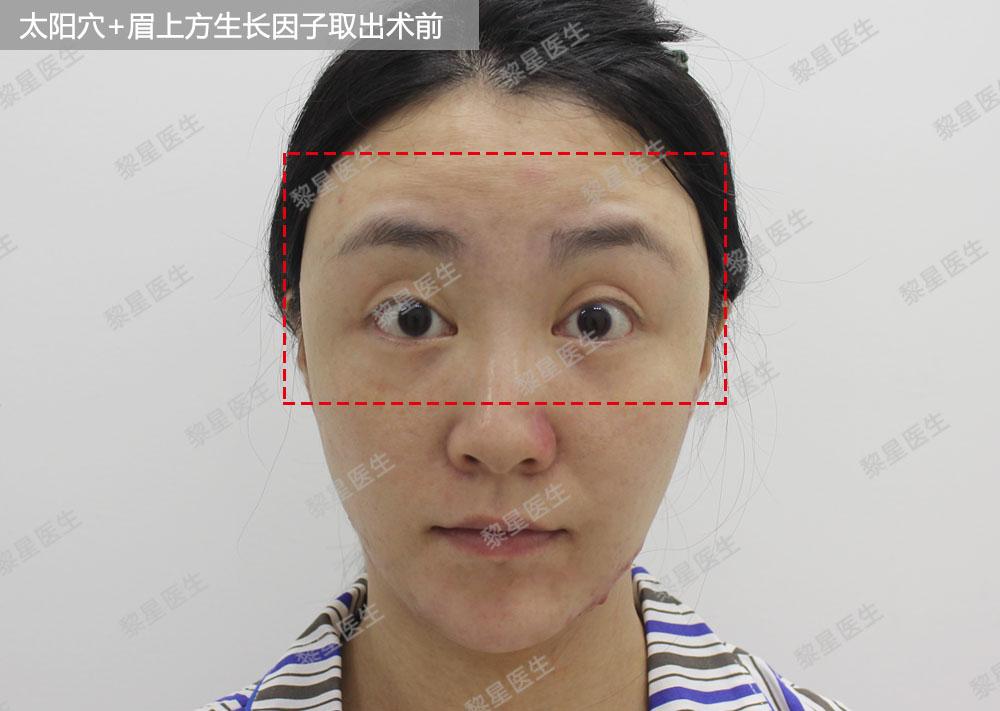 生长因子填充面部能维持多久,复读真的有用吗